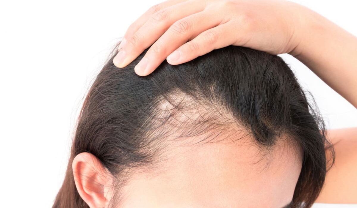 ما هي الحلول الطبية لعلاج مشكلة فقدان الشعر؟!